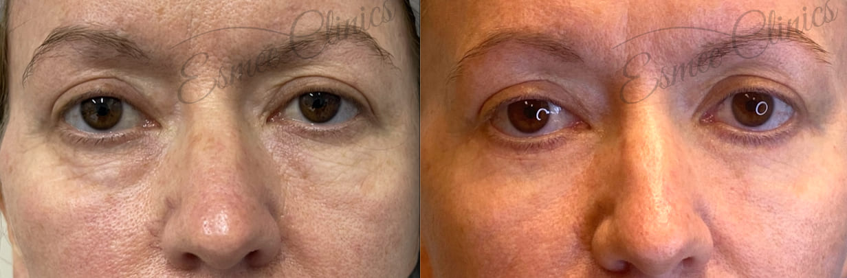 Before and After img